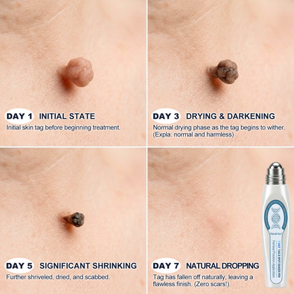 𝐏𝐡𝐚𝐫𝐦𝐚𝐜𝐢𝐬𝐭 𝐑𝐞𝐜𝐨𝐦𝐦𝐞𝐧𝐝𝐞𝐝 ✅ 𝐇𝐞𝐚𝒍𝒓𝒊𝒛𝗲® 𝟳-𝗗𝐚𝐲 𝐓𝐚𝐠 & 𝐒𝒑𝒐𝒕 𝑬𝒓𝒂𝒔𝒆𝒓 🪄 (𝒁𝒆𝒓𝒐𝗣𝗮𝗶𝗻, 𝗭𝗲𝗿𝗼 𝗦𝗰𝗮𝗿𝘀 𝗥𝗼𝗹𝗹𝗲𝗿𝗯𝗮𝗹𝗹) 👩‍⚕️