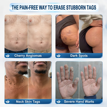 𝐏𝐡𝐚𝐫𝐦𝐚𝐜𝐢𝐬𝐭 𝐑𝐞𝐜𝐨𝐦𝐦𝐞𝐧𝐝𝐞𝐝 ✅ 𝐇𝐞𝐚𝒍𝒓𝒊𝒛𝗲® 𝟳-𝗗𝐚𝐲 𝐓𝐚𝐠 & 𝐒𝒑𝒐𝒕 𝑬𝒓𝒂𝒔𝒆𝒓 🪄 (𝒁𝒆𝒓𝒐𝗣𝗮𝗶𝗻, 𝗭𝗲𝗿𝗼 𝗦𝗰𝗮𝗿𝘀 𝗥𝗼𝗹𝗹𝗲𝗿𝗯𝗮𝗹𝗹) 👩‍⚕️